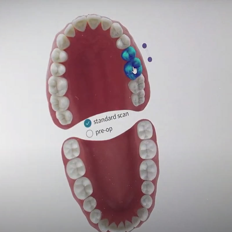 Dynamix implants